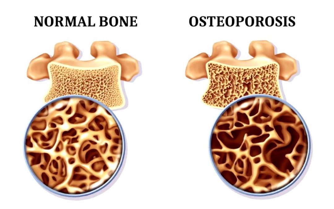 Yoga: A way to improve Osteoporosis ?