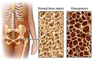 yoga osteoporosis